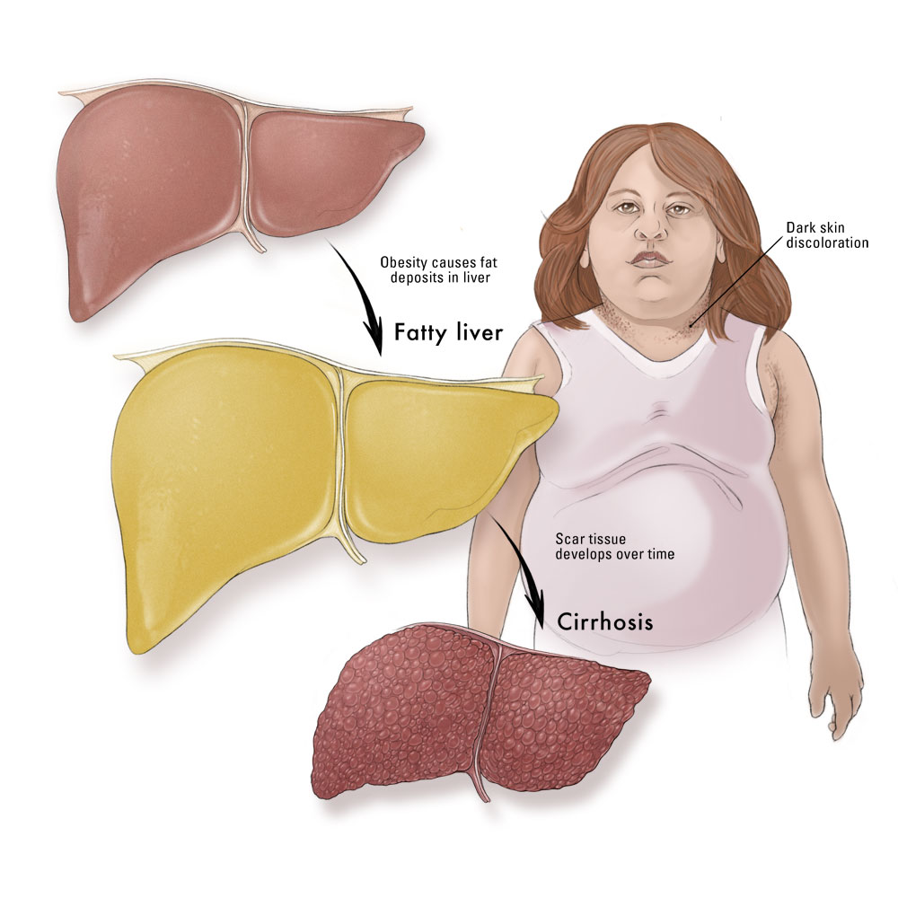 Teen NonAlcoholic Fatty Liver Disease On Rise