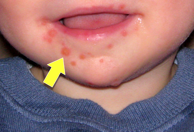 mystery-rash-on-toddler-babycenter