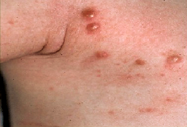 Axillary rash with itching - Dermatology - MedHelp