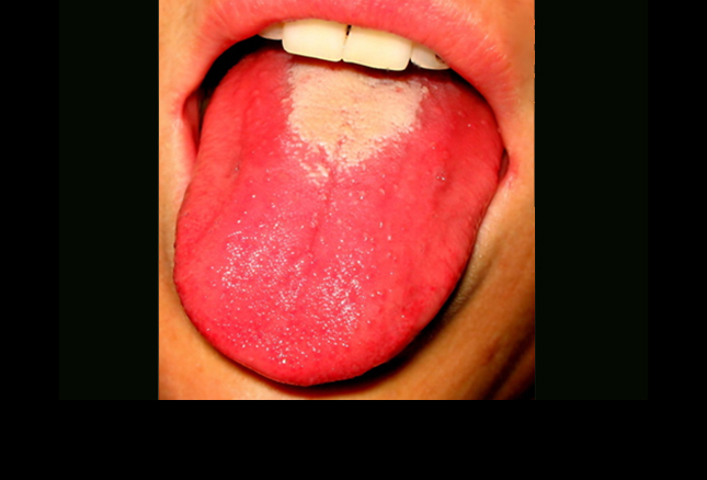 Strep Rash On Tongue