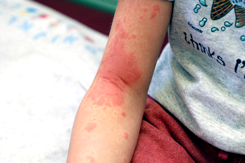 What Does Poison Ivy Rash Look Like When Healing