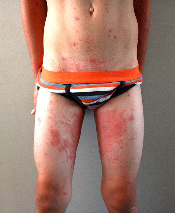 Groin rash - RightDiagnosis.com