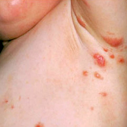 Scabies : MedlinePlus Medical Encyclopedia