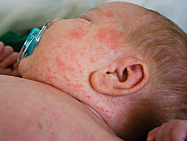 Is It Baby Acne, or Rash, or Something Else? - Healthline