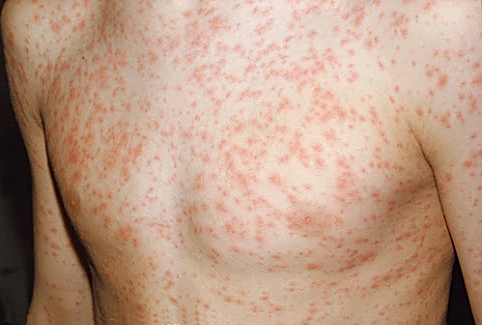 Rubella (German Measles) - KidsHealth