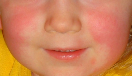 numbered-rash-diseases-of-childhood-second-disease-scarlet-fever