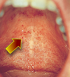 Pictures Of Red Spots On Palate 51