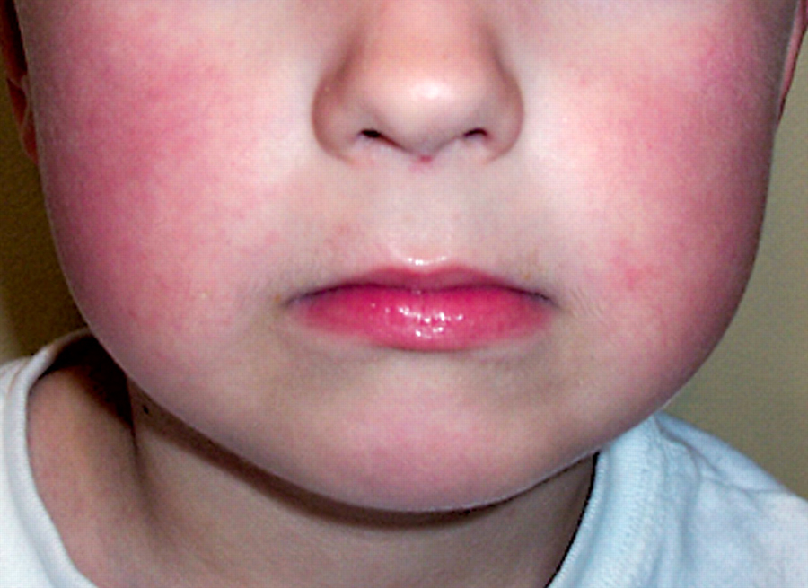 Rash on cheeks - RightDiagnosis.com