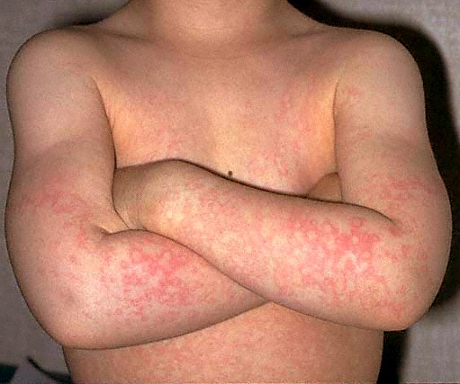 Rash 101: The Most Common Types of Skin Rashes