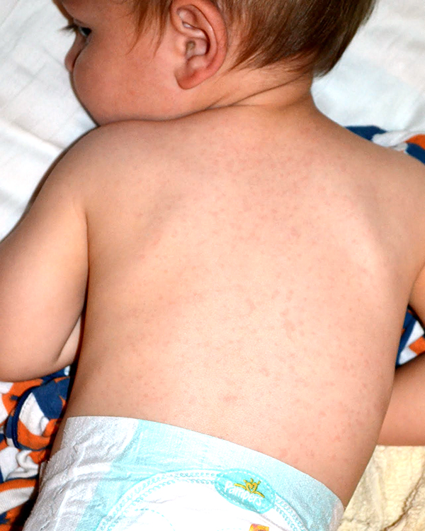 Roseola Rash