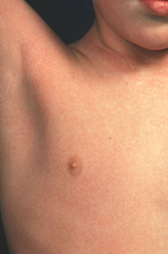 Scarlet Fever Picture Image on MedicineNet.com