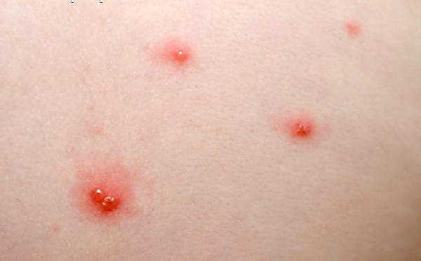 Pictures Of Chickenpox Day 1