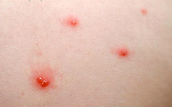 Itchy, bumpy rash - Dermatology - MedHelp