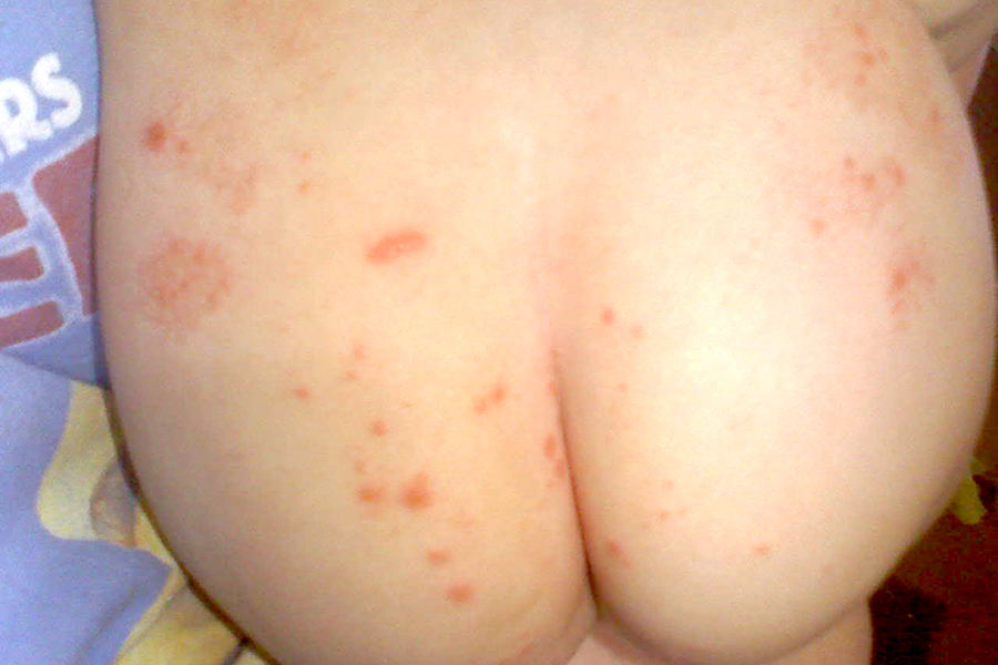 herpes on buttock pictures #11