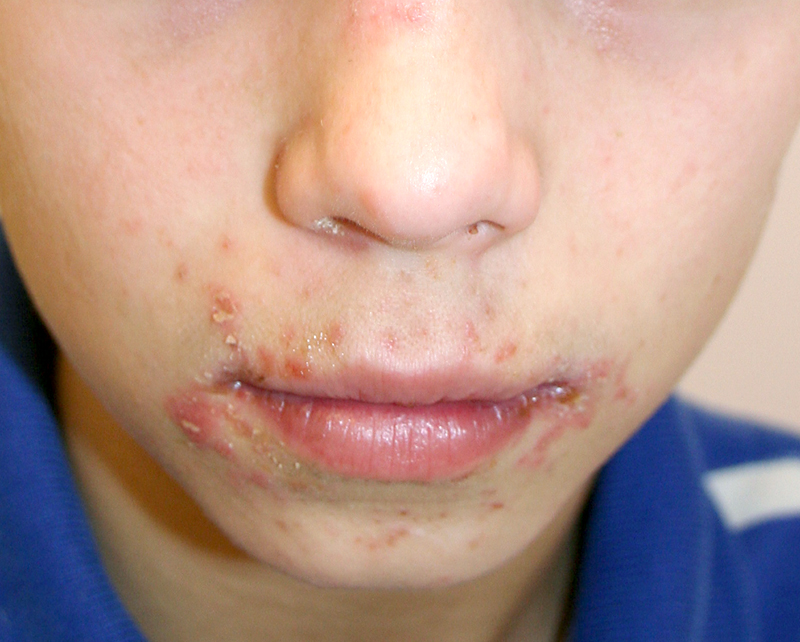 impetigo pictures child