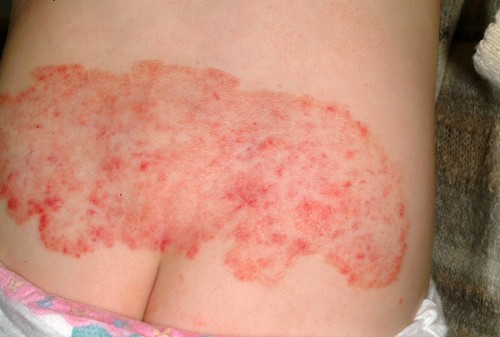 Shingles Rash Pictures On Buttocks – Living With Herpes