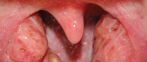 When Do Tonsils Develop In Babies: Everything You Need To Know