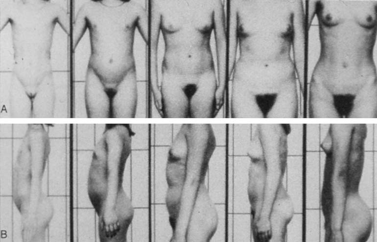 Puberty Breast Development Stages