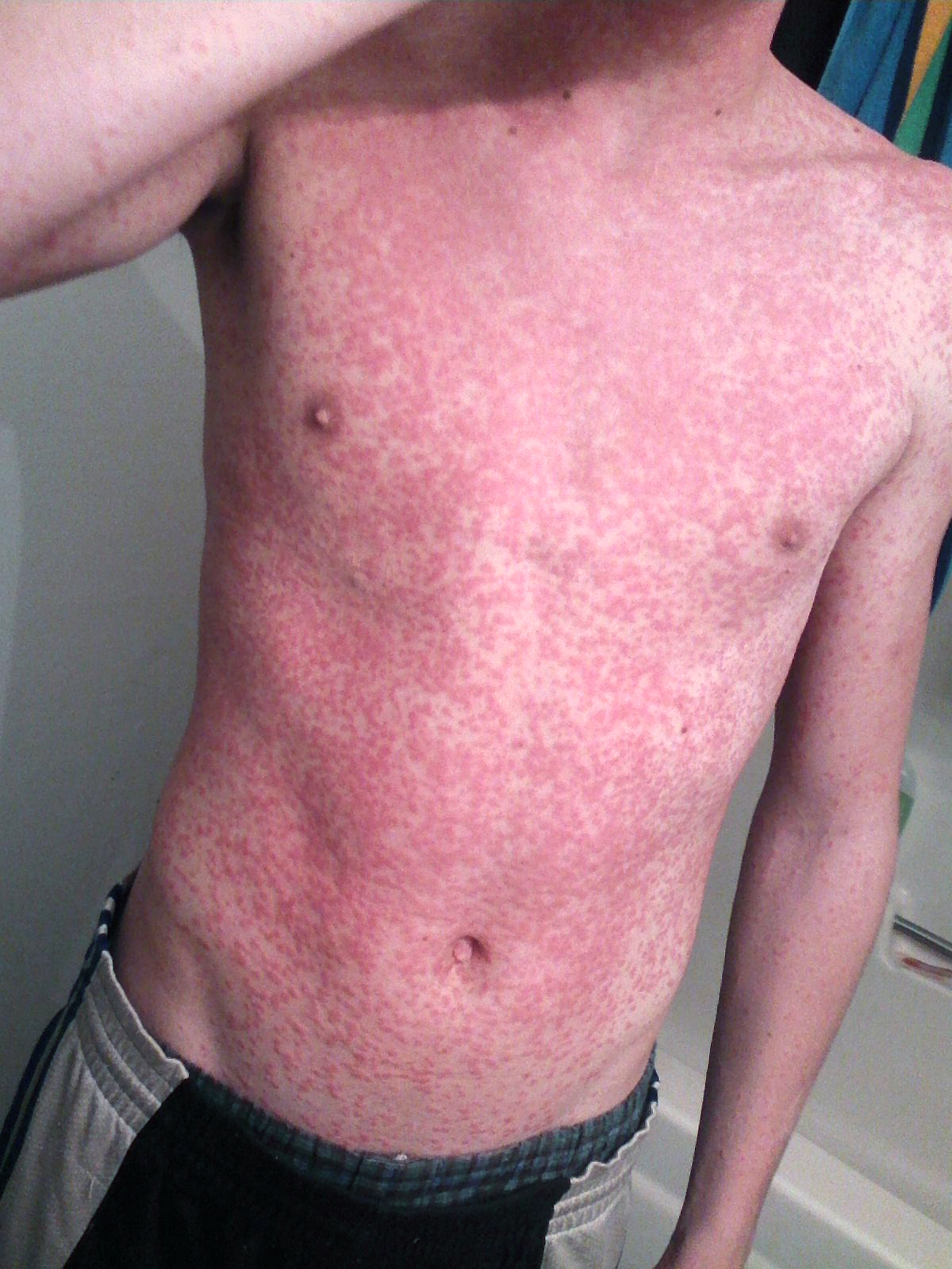 pictures of fifth disease #11