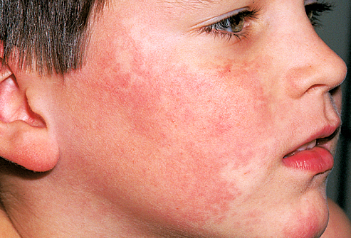 Skin Rashes in Children: Click for Facts on Common Rashes