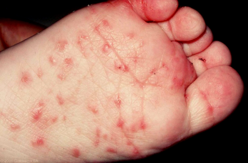 Scabies Treatment - HealthyChildren.org