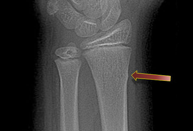 acute buckle fracture wrist