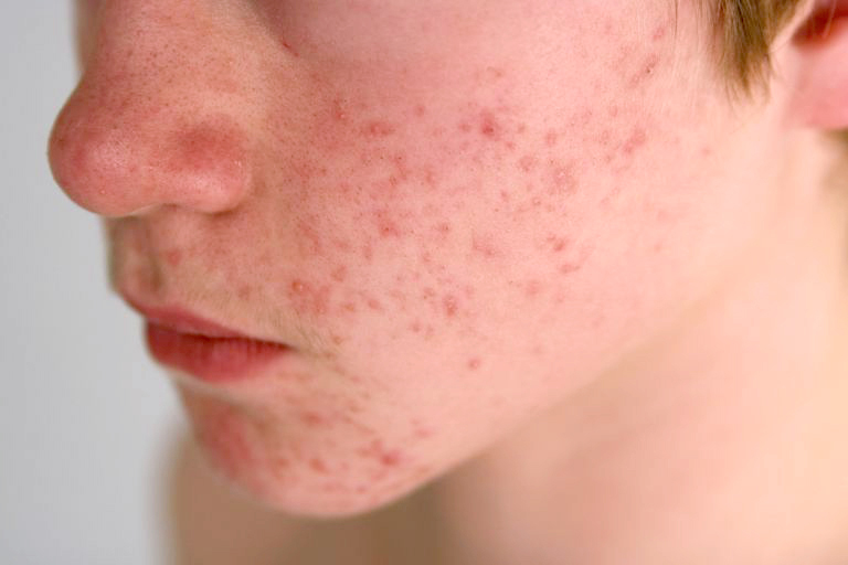 Puberty Acne And Beyond Most Internet Information Wrong