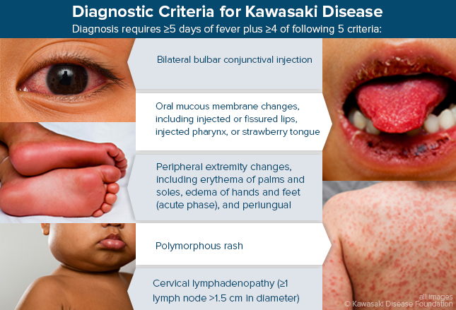 kawasaki disease fever