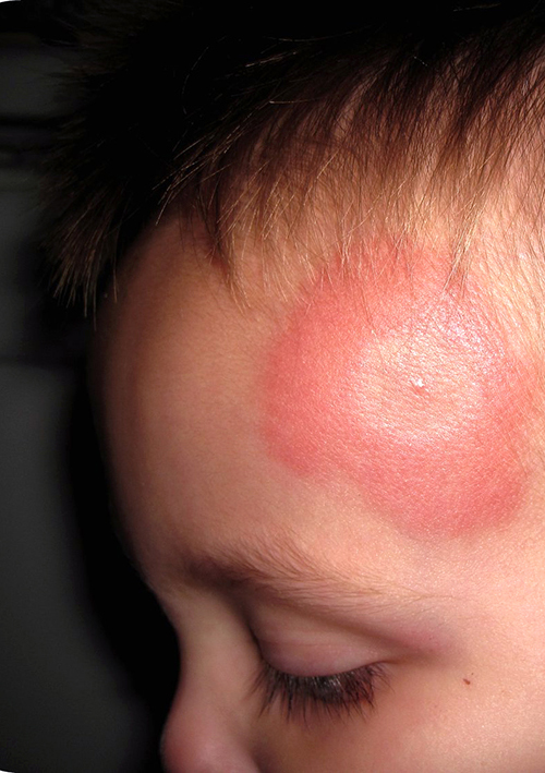 Summer Childhood Illnesses And Injuries 2