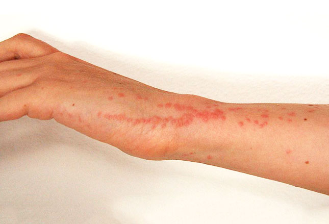 Excoriation | Define Excoriation at Dictionary.com