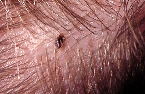 lice close up