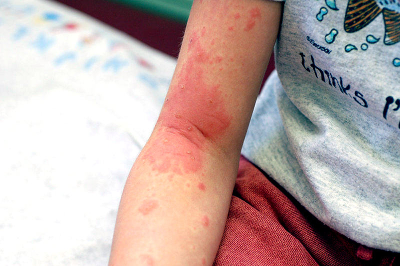 Poison Ivy Oak And Sumac In Children