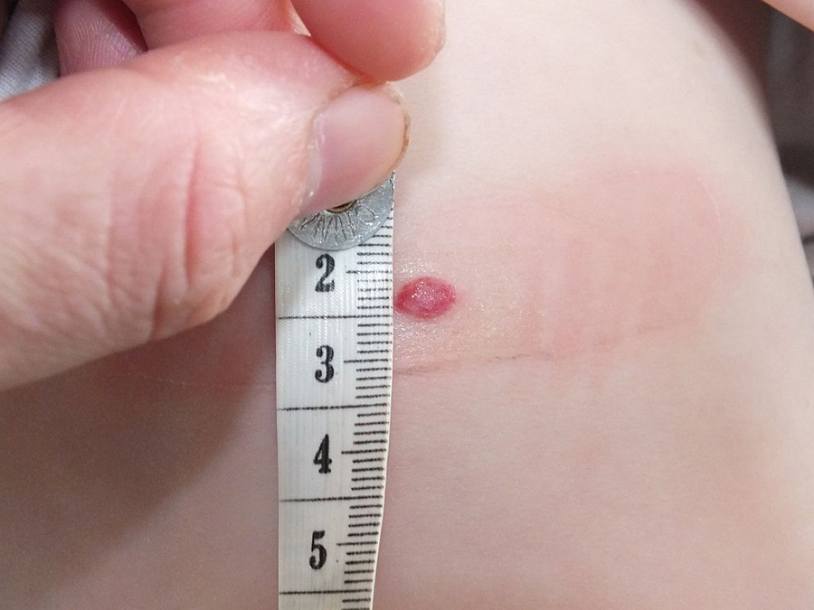 Topical Gel Helpful In Some Infantile Hemangiomas