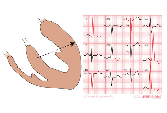 Sudden Cardiac Death in Child Athletes